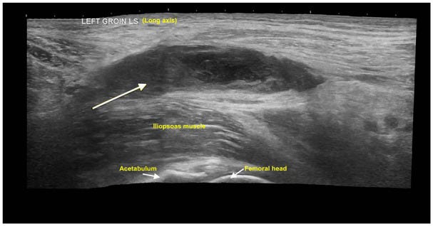 Hernia parte III Ecografia tempo formacion.jpg
